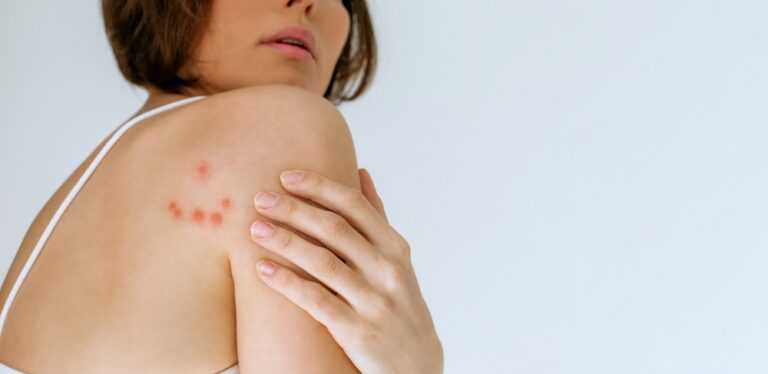 What Do Bed Bug Bites Look Like?