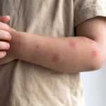 A child wearing a beige shirt scratches their left forearm, which has several red bumps or spots—possible symptoms of a cockroach bite, rash, or allergic reaction that may require treatment.